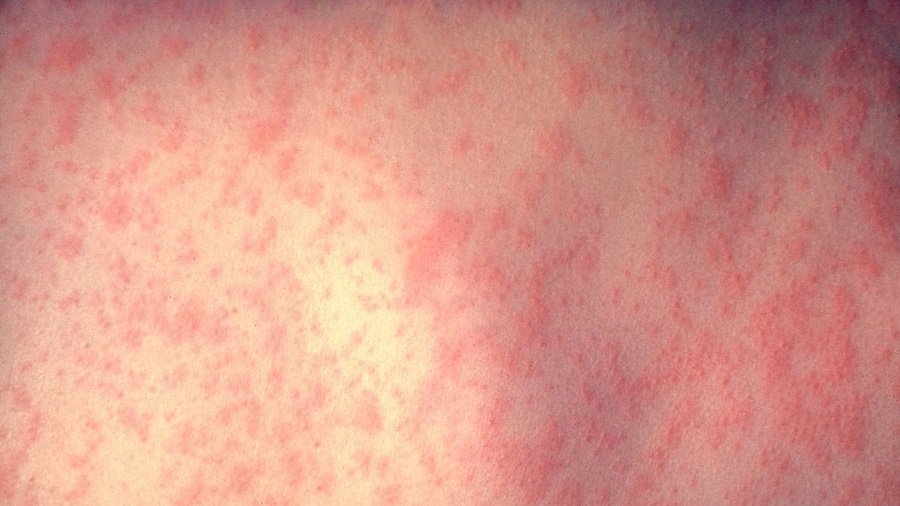 Per pastaruosius dvejus metus Europoje nuo tymų mirė 49 žmonės - Įdomu žinoti